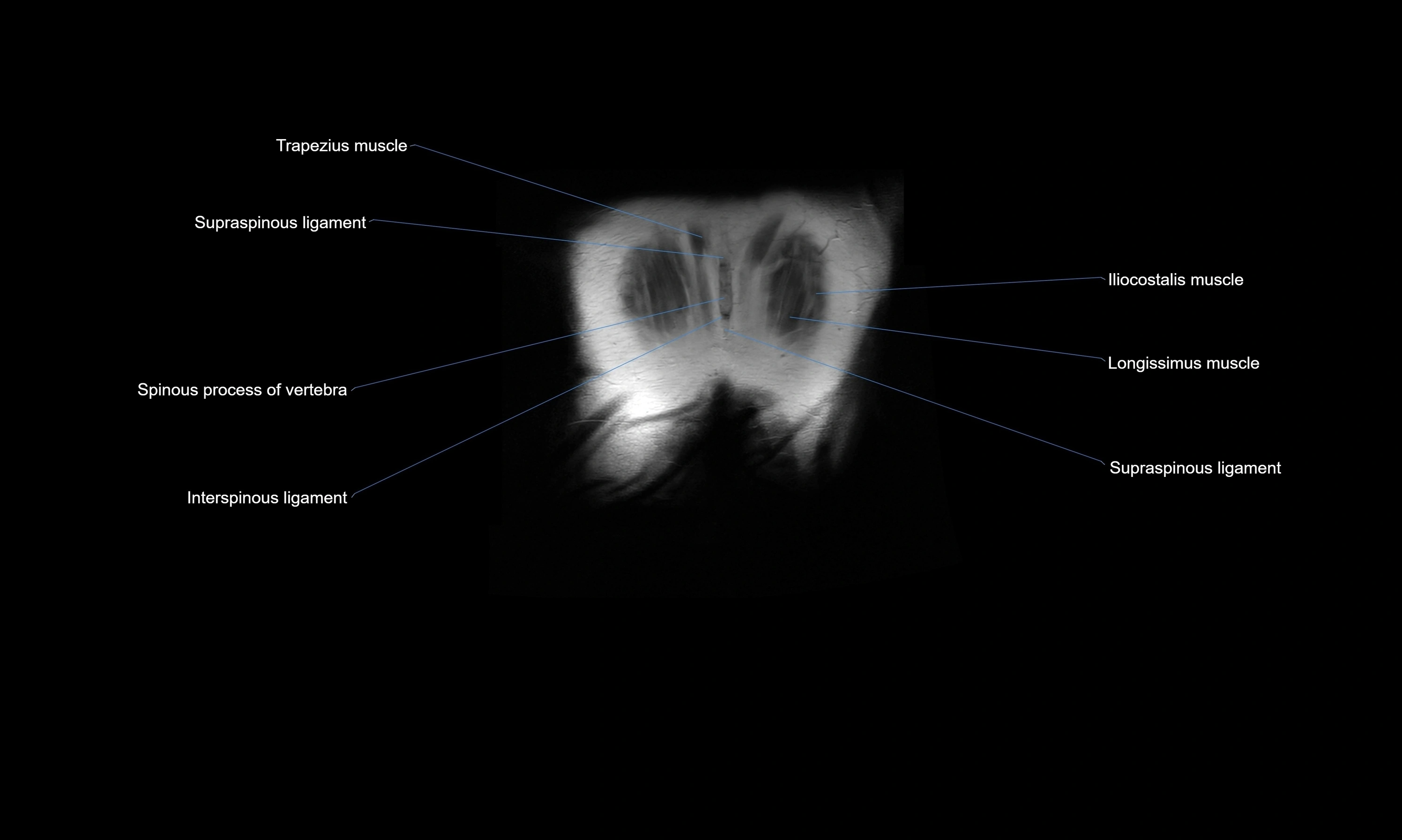 MRI Abdomen axial cross sectional anatomy radiology  image-img-00001-00057.webp